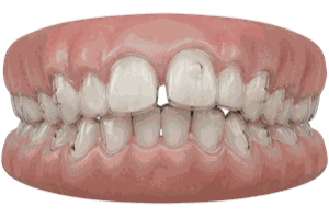Invisalign