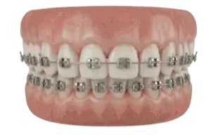 Braces