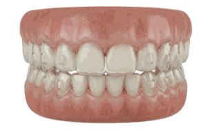 Clear Aligners