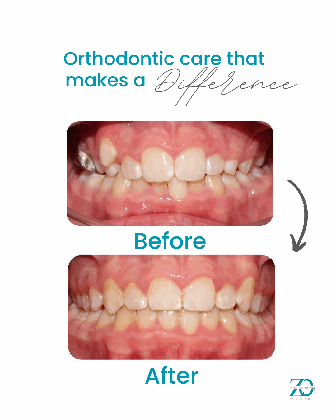 Before and after orthodontic results at Zipper Orthodontics