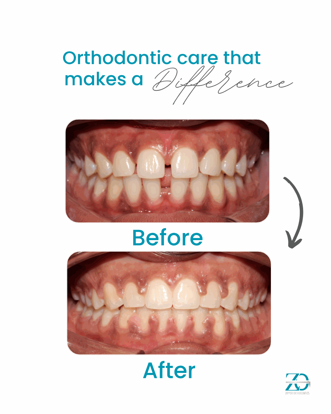 Before and after orthodontic results at Zipper Orthodontics