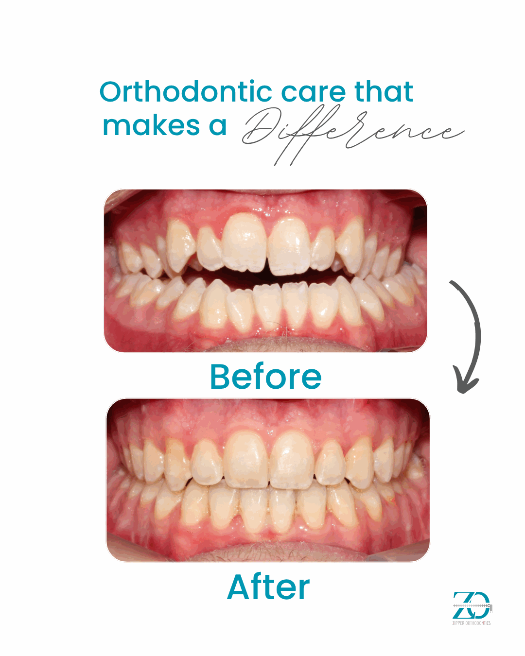Before and after orthodontic results at Zipper Orthodontics