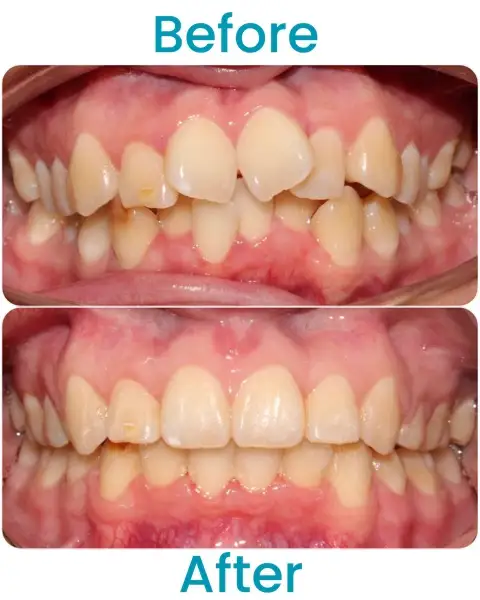 Before and After