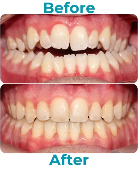 Before and After