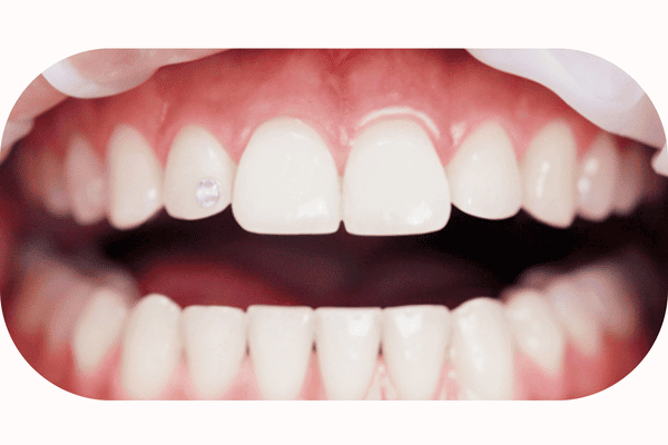 Tooth Gems